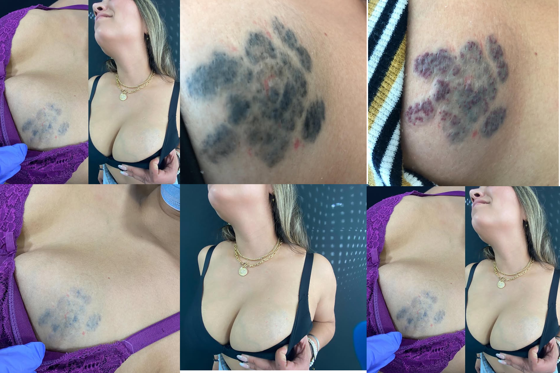Tattoo Removal Before After 2