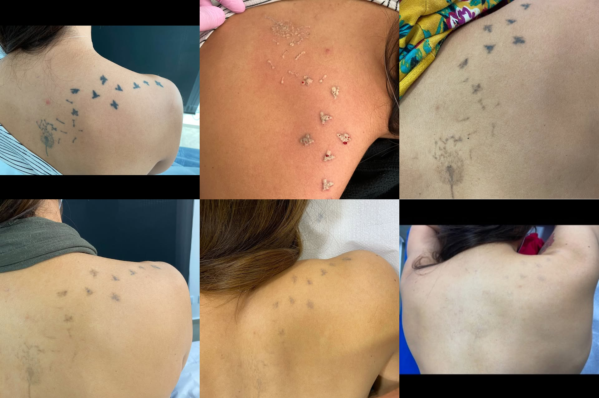 Tattoo Removal Before After 3