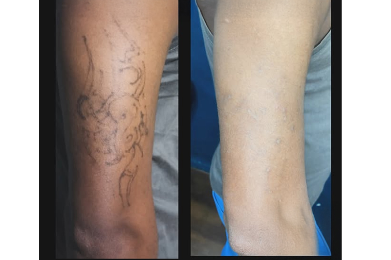 Tattoo Removal Before After 4