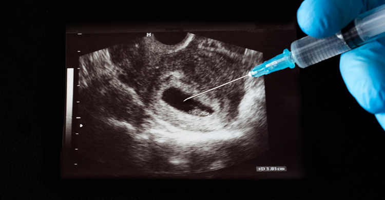 Abortion Treatment