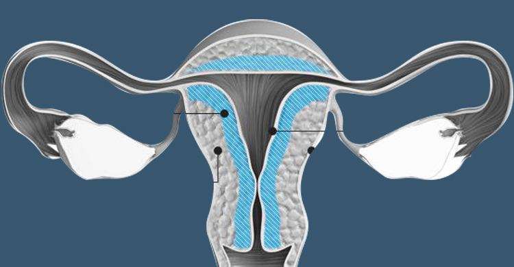 Adenomyosis Treatment