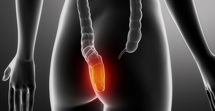 Anal Fissure Treatment