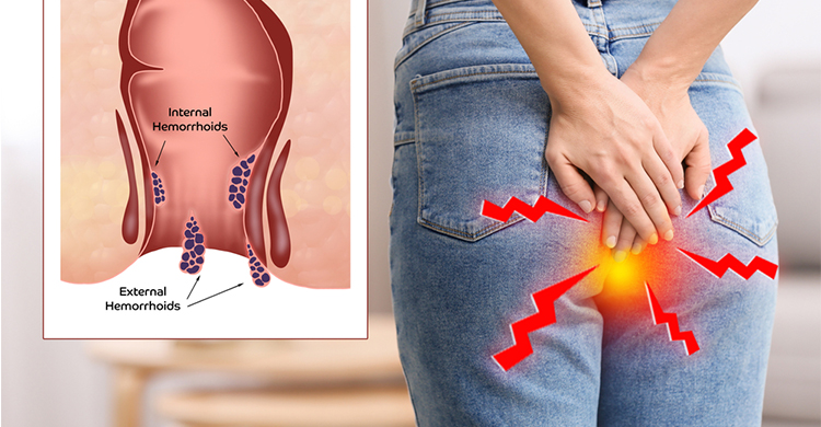 Anal Fistula Treatment