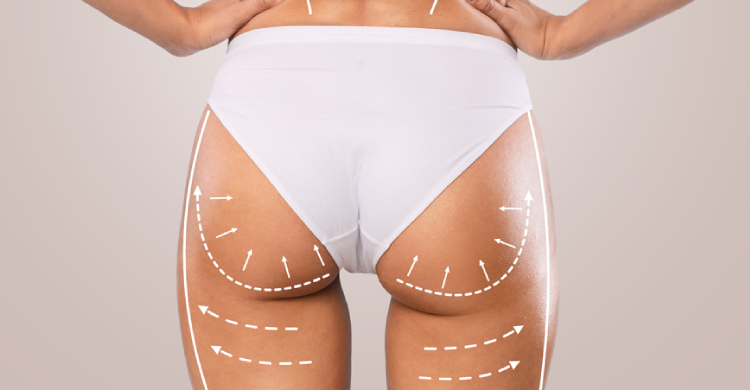 Brazilian Buttock Lift