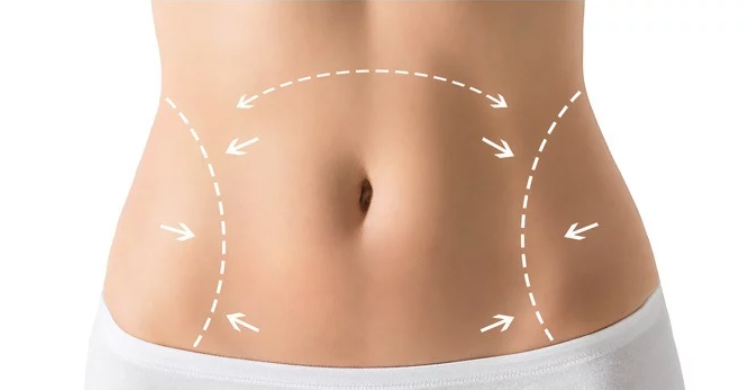 Body Lift Surgery