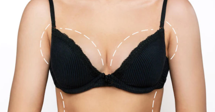 Breast Lift
