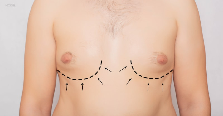 Male Breast Reduction Surgery