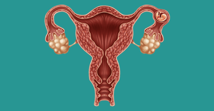 Ectopic Pregnancy Treatment