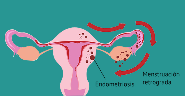 Endometriosis Treatment