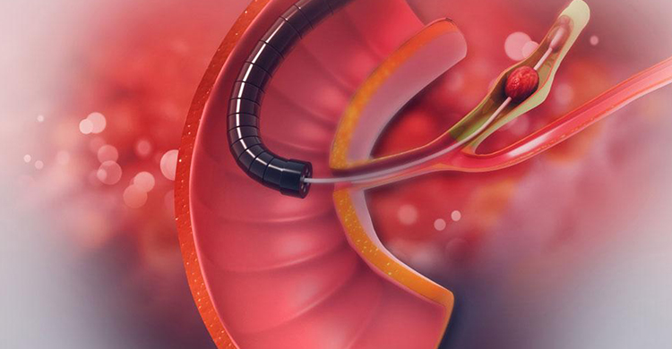 Gallstones Treatment