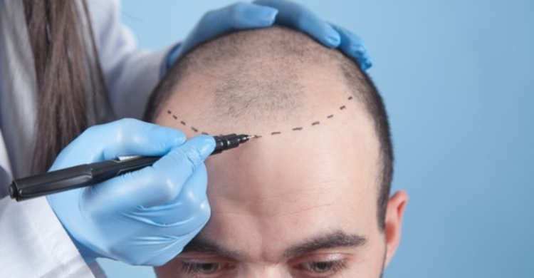 Advanced Hair Transplant Surgery
