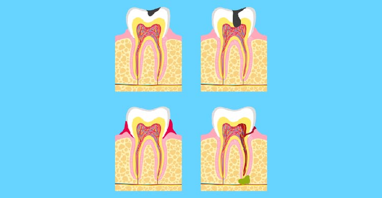 Advance Root Canal Treatment