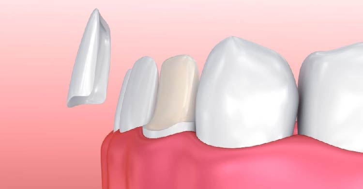 Dental Veeners