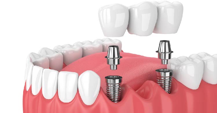 Dental Implant Treatment