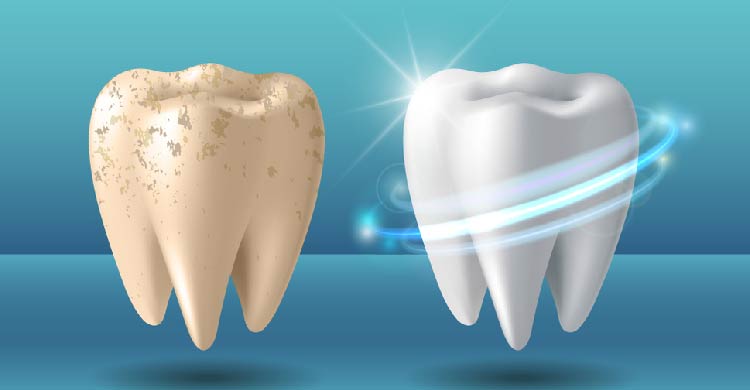 Teeth Whitening