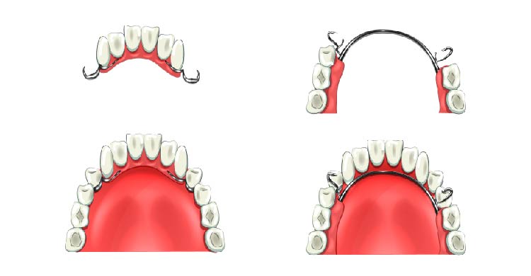 Complete Denture/Removable Partial Dentures
