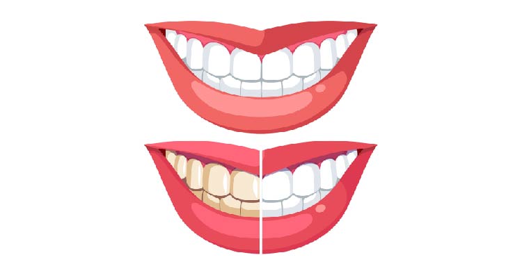 Scaling & Polishing