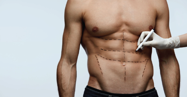 Male Liposuction
