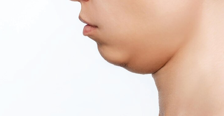 Double Chin Liposuction