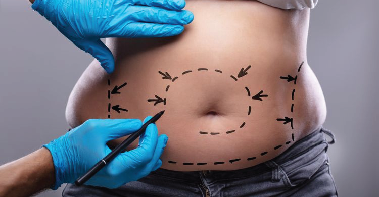 Stomach Liposuction
