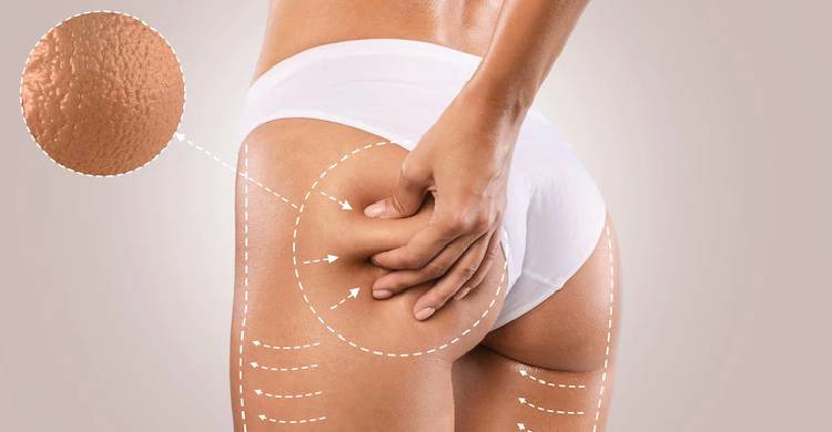 Hip Liposuction