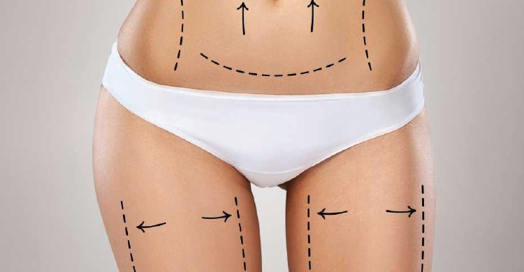 Mega Liposuction