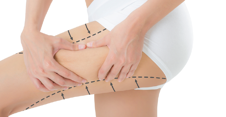 Thighs Liposuction