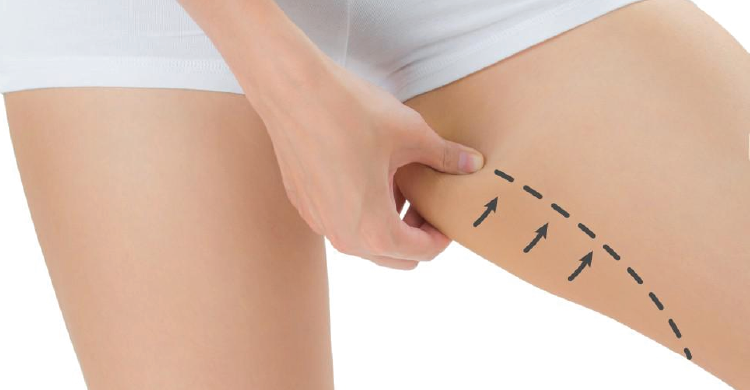 Inner Thighs Liposuction