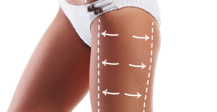 Saddlebag Liposuction