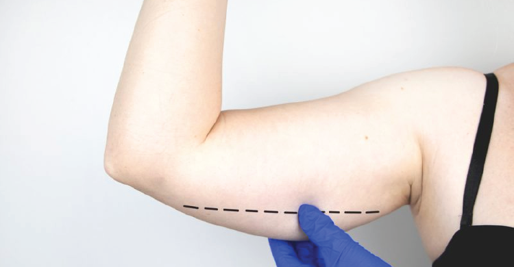 Arm Liposuction