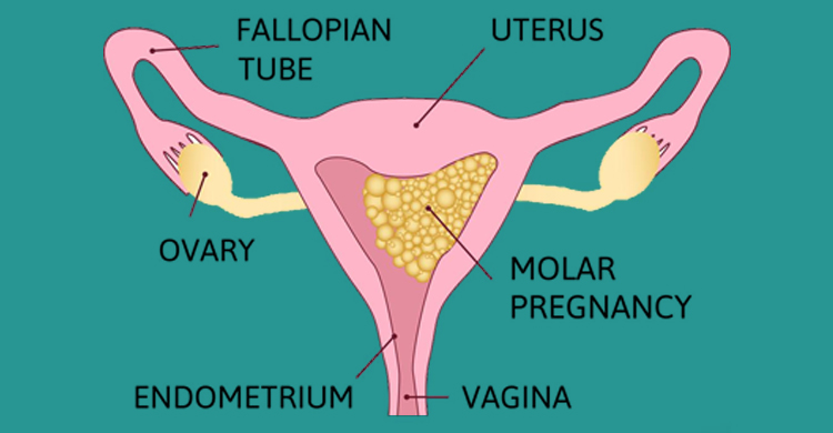 Molar Pregnancy Treatment