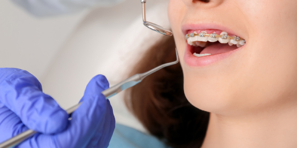 Orthodontic Braces