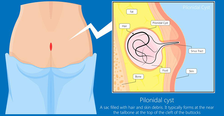 Pilonidal Sinus Treatment