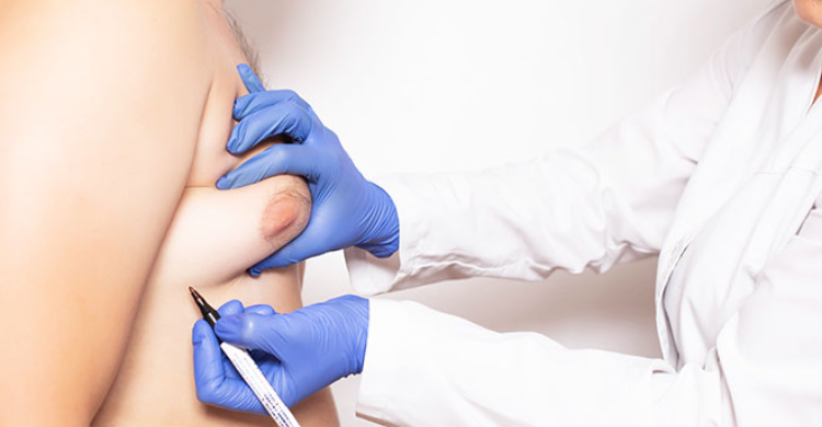 Tumescent Liposuction