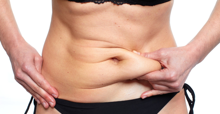 Tummy Tuck