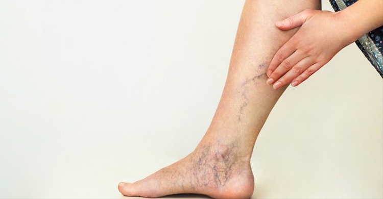 Varicose Veins Treatment