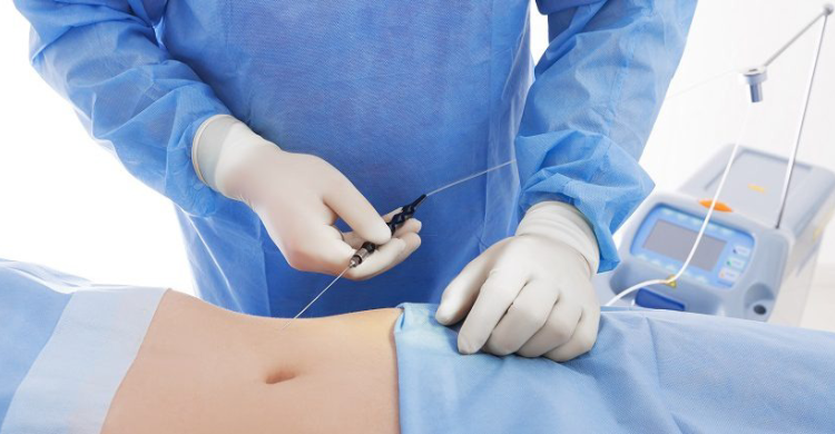Vaser Liposuction